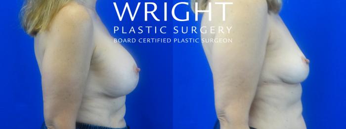 Before & After Breast Implant Removal Case 36 Right Side View in Little Rock, Arkansas