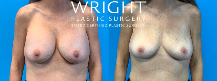 Before & After Breast Implant Removal Case 362 Front View in Little Rock, Arkansas