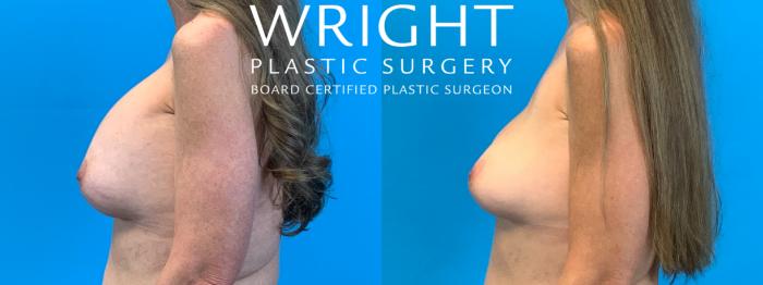 Before & After Breast Implant Removal Case 362 Left Side View in Little Rock, Arkansas