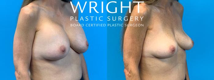 Before & After Breast Implant Removal Case 362 Right Oblique View in Little Rock, Arkansas