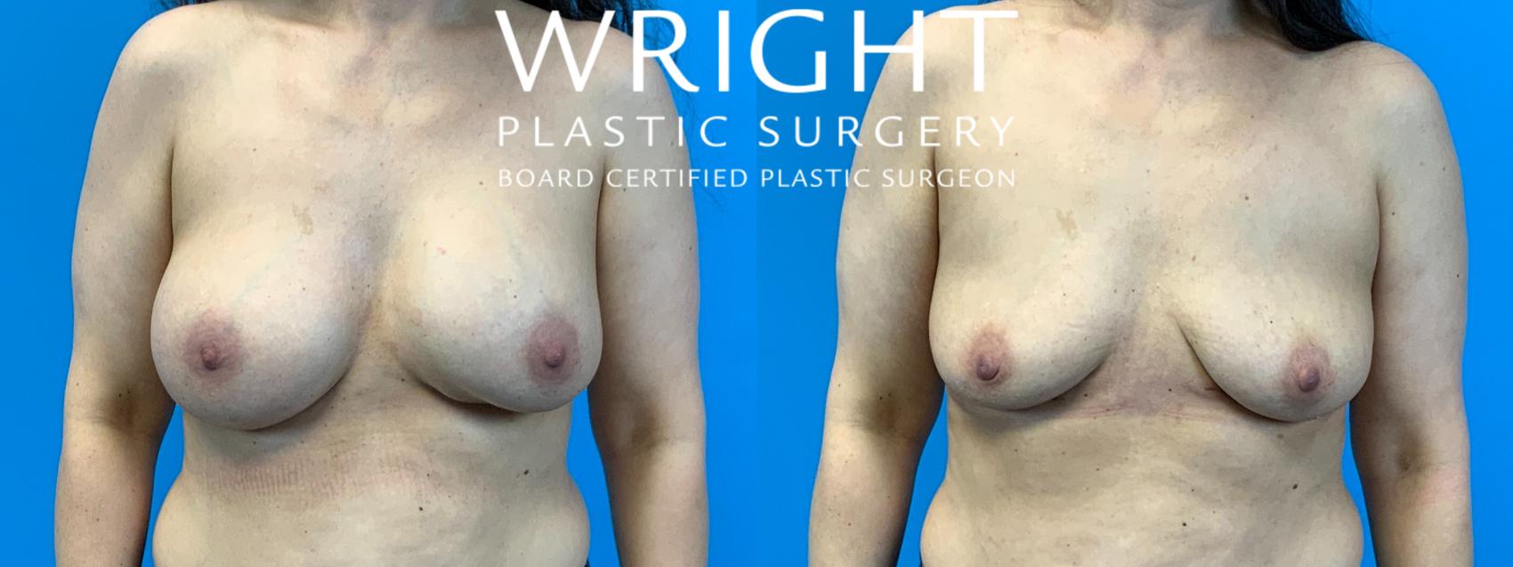 Before & After Breast Implant Removal Case 367 Front View in Little Rock, Arkansas