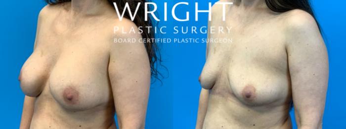 Before & After Breast Implant Removal Case 367 Left Oblique View in Little Rock, Arkansas