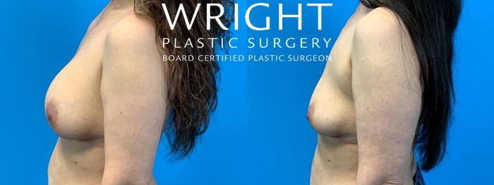 Before & After Breast Implant Removal Case 367 Left Side View in Little Rock, Arkansas