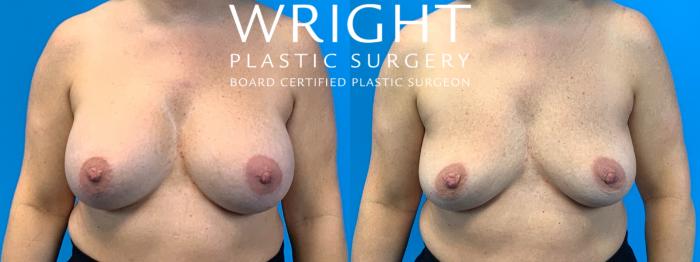 Before & After Breast Implant Removal Case 368 Front View in Little Rock, Arkansas