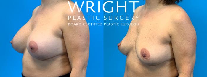 Before & After Breast Implant Removal Case 368 Left Oblique View in Little Rock, Arkansas