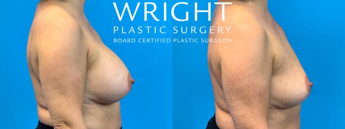 Before & After Breast Implant Removal Case 368 Right Side View in Little Rock, Arkansas