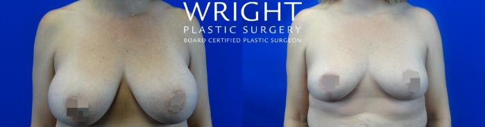 Before & After Breast Implant Removal Case 37 Front View in Little Rock, Arkansas