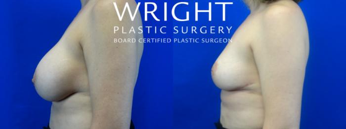 Before & After Breast Implant Removal Case 37 Left Side View in Little Rock, Arkansas