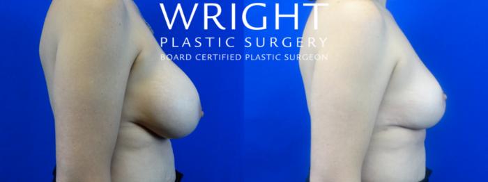 Before & After Breast Implant Removal Case 37 Right Side View in Little Rock, Arkansas