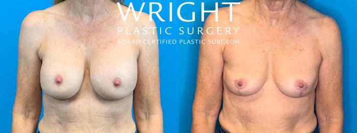 Before & After Breast Implant Removal Case 371 Front View in Little Rock, Arkansas