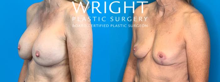 Before & After Breast Implant Removal Case 371 Left Oblique View in Little Rock, Arkansas