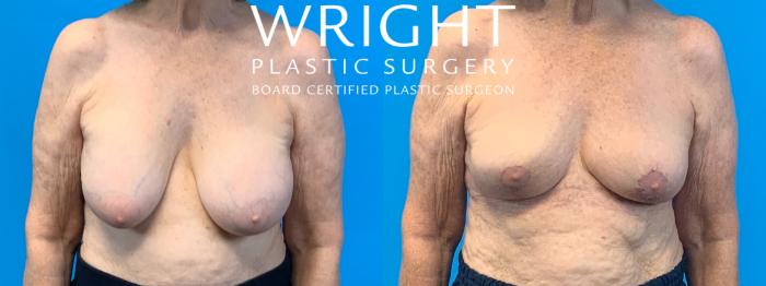 Before & After Breast Lift Case 378 Front View in Little Rock, Arkansas