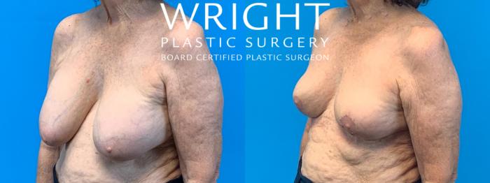 Before & After Breast Implant Removal Case 378 Left Oblique View in Little Rock, Arkansas