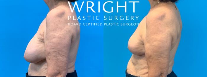 Before & After Breast Implant Removal Case 378 Left Side View in Little Rock, Arkansas
