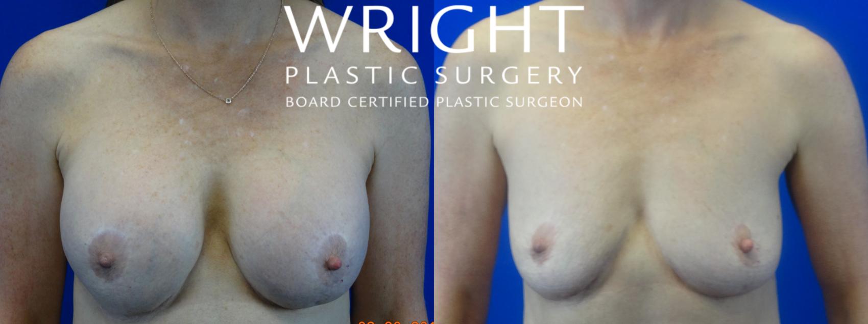 Before & After Breast Implant Removal Case 38 Front View in Little Rock, Arkansas