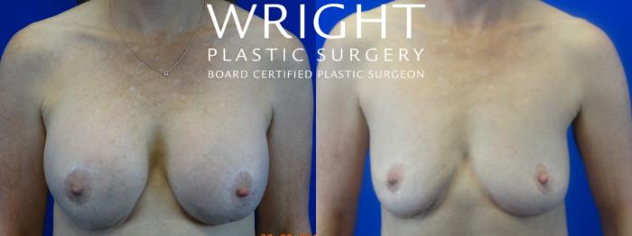 Before & After Breast Implant Removal Case 38 Front View in Little Rock, Arkansas