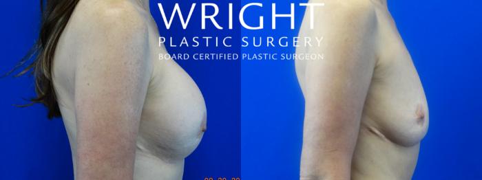 Before & After Breast Implant Removal Case 38 Right Side View in Little Rock, Arkansas