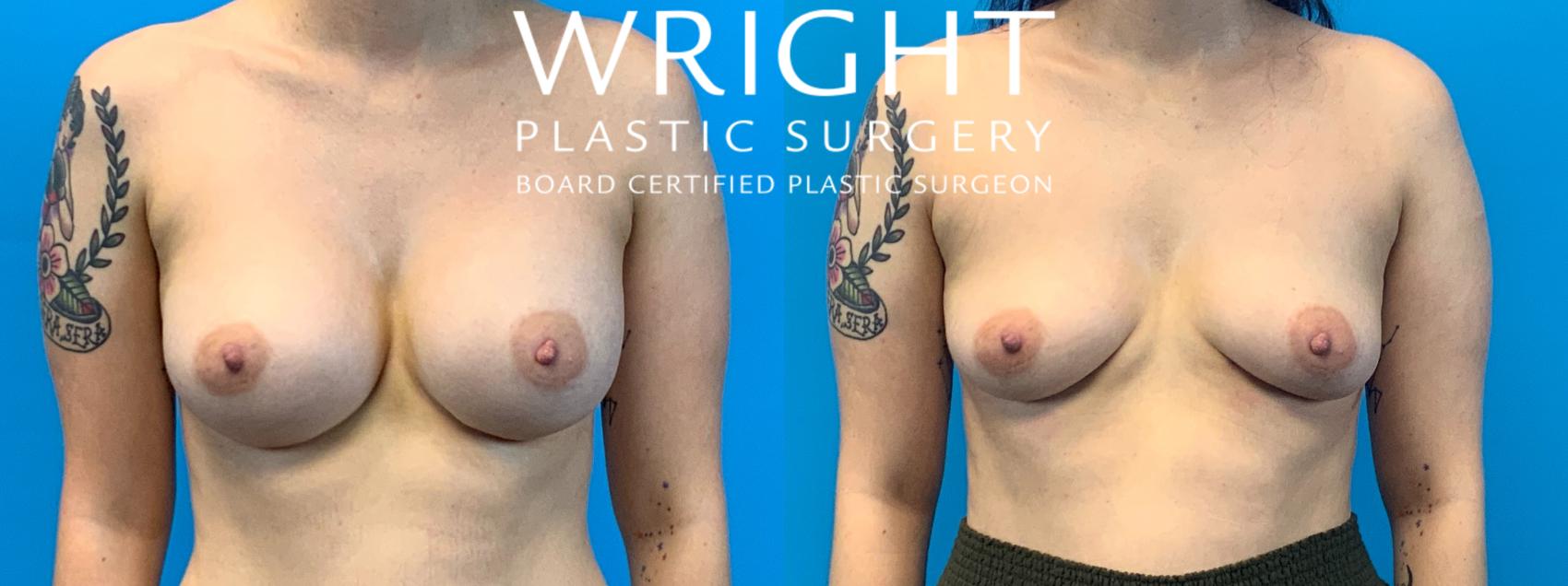 Before & After Breast Implant Removal Case 391 Front View in Little Rock, Arkansas