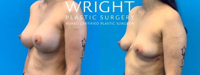 Before & After Breast Implant Removal Case 391 Left Oblique View in Little Rock, Arkansas