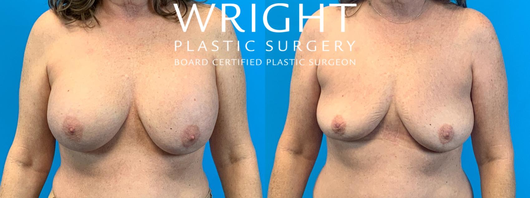 Before & After Breast Implant Removal Case 392 Front View in Little Rock, Arkansas