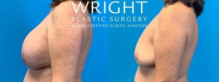 Before & After Breast Implant Removal Case 392 Left Side View in Little Rock, Arkansas