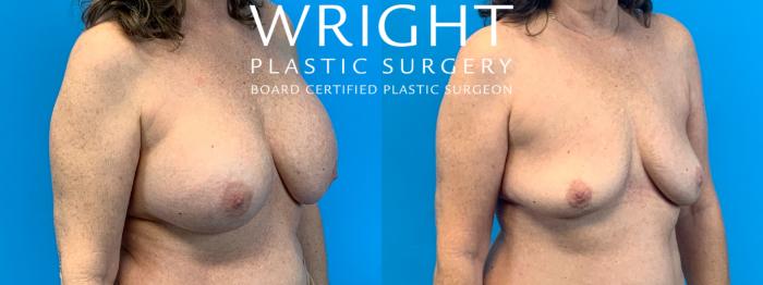 Before & After Breast Implant Removal Case 392 Right Oblique View in Little Rock, Arkansas