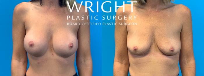 Before & After Breast Implant Removal Case 394 Front View in Little Rock, Arkansas
