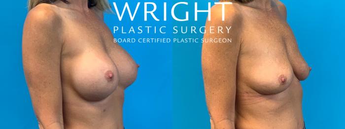 Before & After Breast Implant Removal Case 394 Right Oblique View in Little Rock, Arkansas