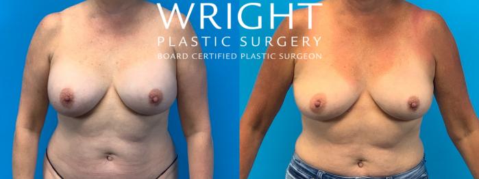 Before & After Breast Implant Removal Case 407 Front View in Little Rock, Arkansas