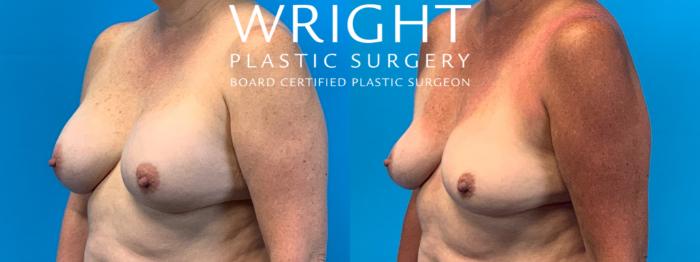 Before & After Breast Implant Removal Case 407 Left Oblique View in Little Rock, Arkansas