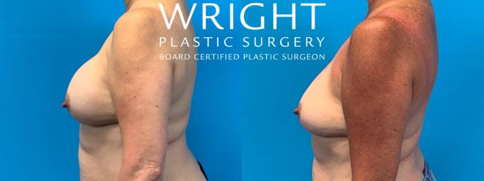 Before & After Breast Implant Removal Case 407 Left Side View in Little Rock, Arkansas