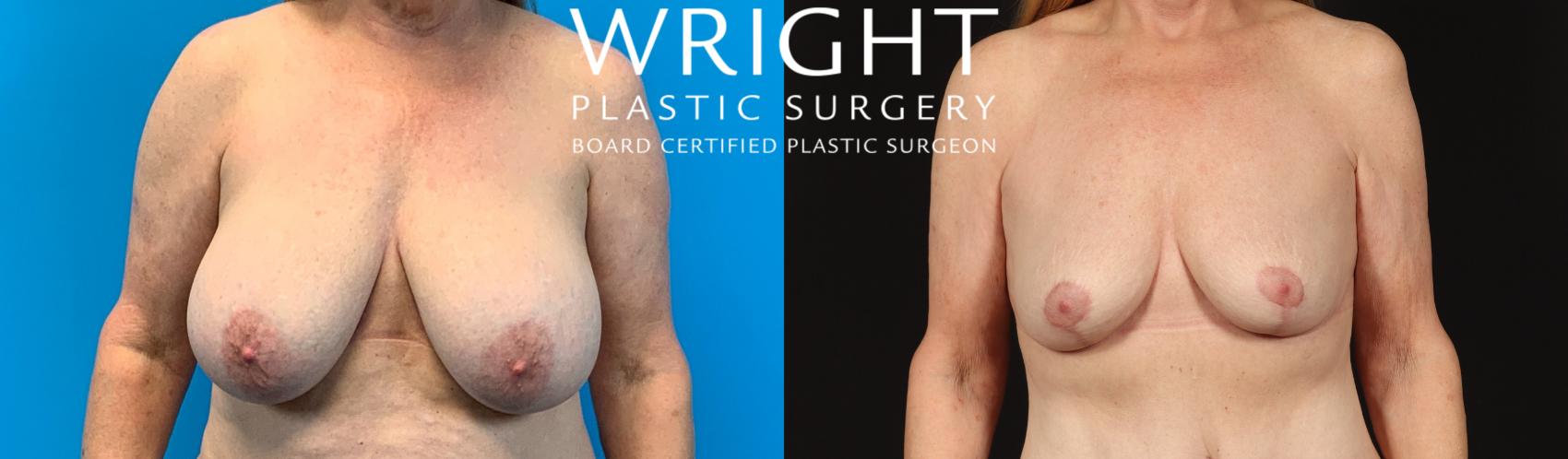 Before & After Breast Lift Case 415 Front View in Little Rock, Arkansas
