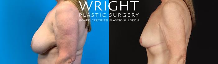 Before & After Breast Implant Removal Case 415 Left Side View in Little Rock, Arkansas
