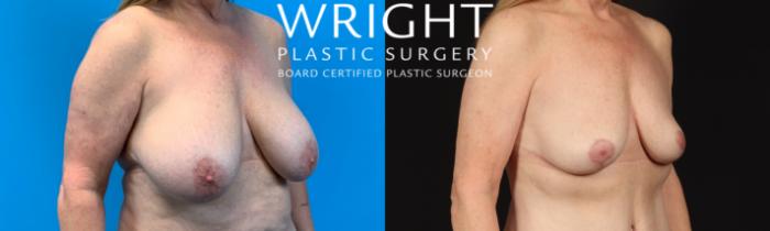 Before & After Breast Lift Case 415 Right Oblique View in Little Rock, Arkansas
