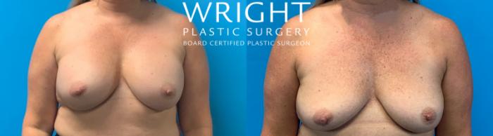 Before & After Breast Implant Removal Case 418 Front View in Little Rock, Arkansas