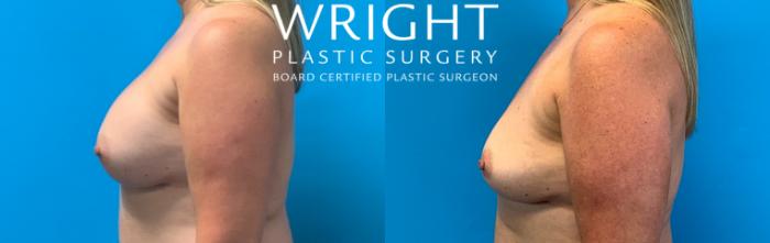 Before & After Breast Implant Removal Case 418 Left Side View in Little Rock, Arkansas