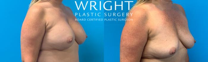 Before & After Breast Implant Removal Case 418 Right Oblique View in Little Rock, Arkansas