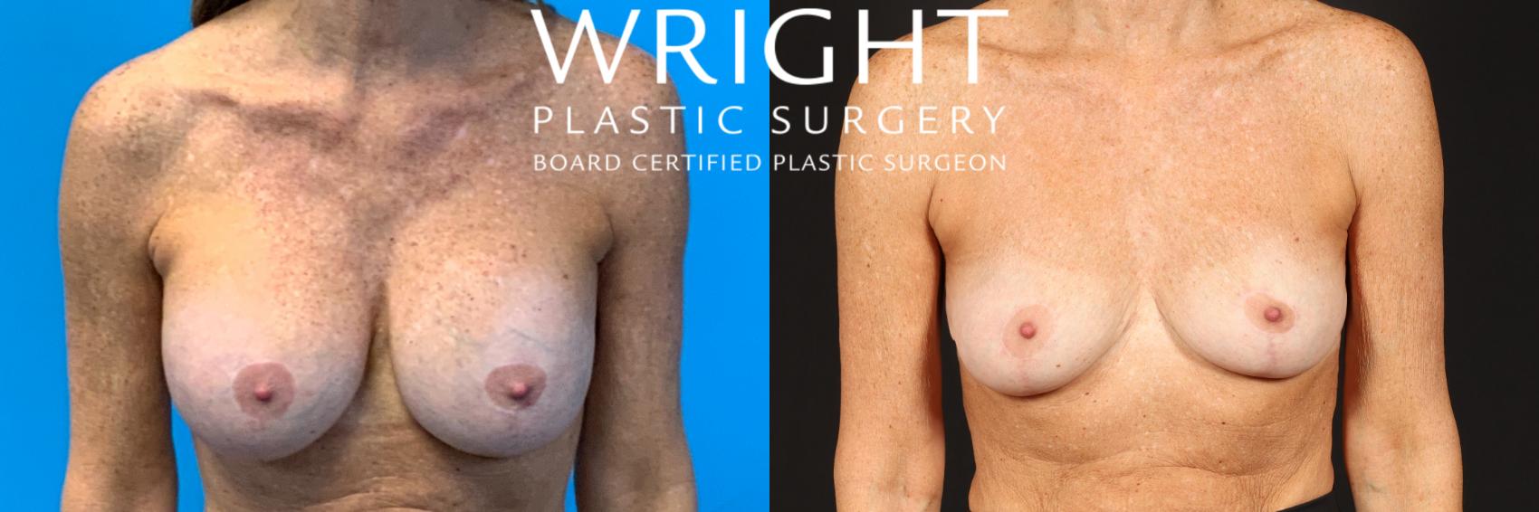 Before & After Breast Implant Removal Case 419 Front View in Little Rock, Arkansas