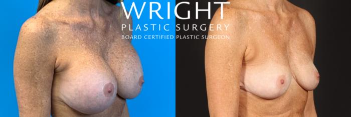 Before & After Breast Implant Removal Case 419 Right Oblique View in Little Rock, Arkansas