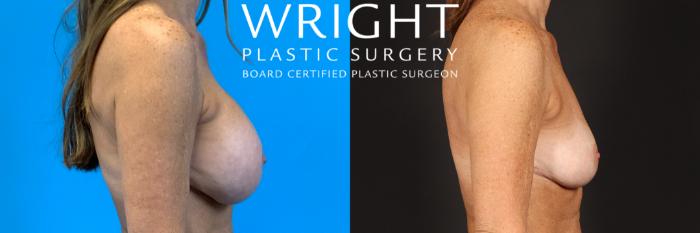 Before & After Breast Implant Removal Case 419 Right Side View in Little Rock, Arkansas