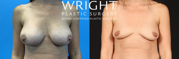 Before & After Breast Implant Removal Case 420 Front View in Little Rock, Arkansas