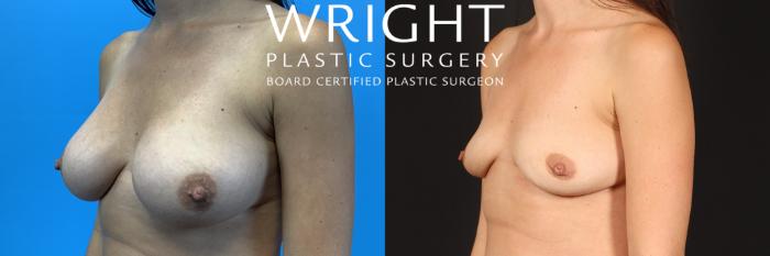 Before & After Breast Implant Removal Case 420 Left Oblique View in Little Rock, Arkansas