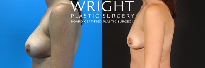 Before & After Breast Implant Removal Case 420 Left Side View in Little Rock, Arkansas