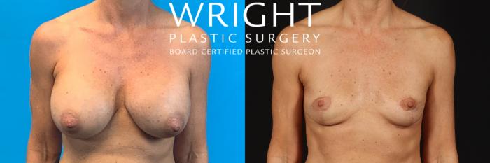 Before & After Breast Implant Removal Case 422 Front View in Little Rock, Arkansas