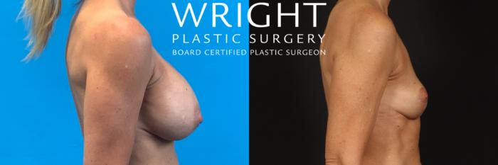 Before & After Breast Lift Case 422 Right Side View in Little Rock, Arkansas