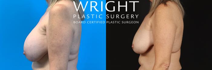 Before & After Breast Implant Removal Case 423 Left Side View in Little Rock, Arkansas