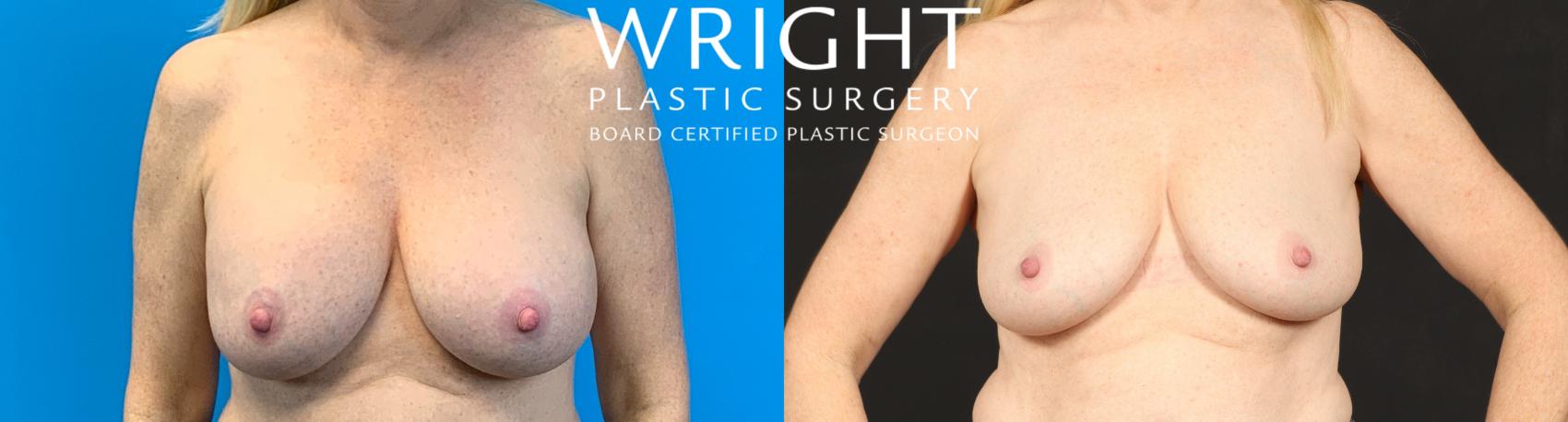 Before & After Breast Implant Removal Case 426 Front View in Little Rock, Arkansas