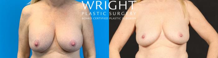 Before & After Breast Implant Removal Case 426 Front View in Little Rock, Arkansas