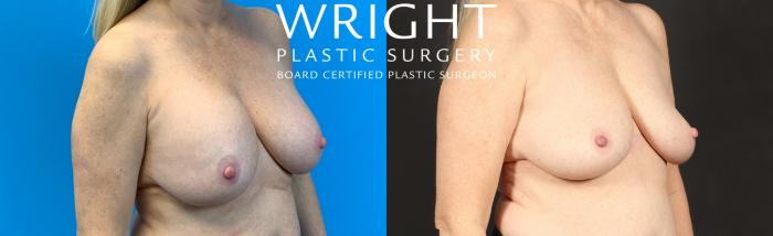 Before & After Breast Implant Removal Case 426 Right Oblique View in Little Rock, Arkansas