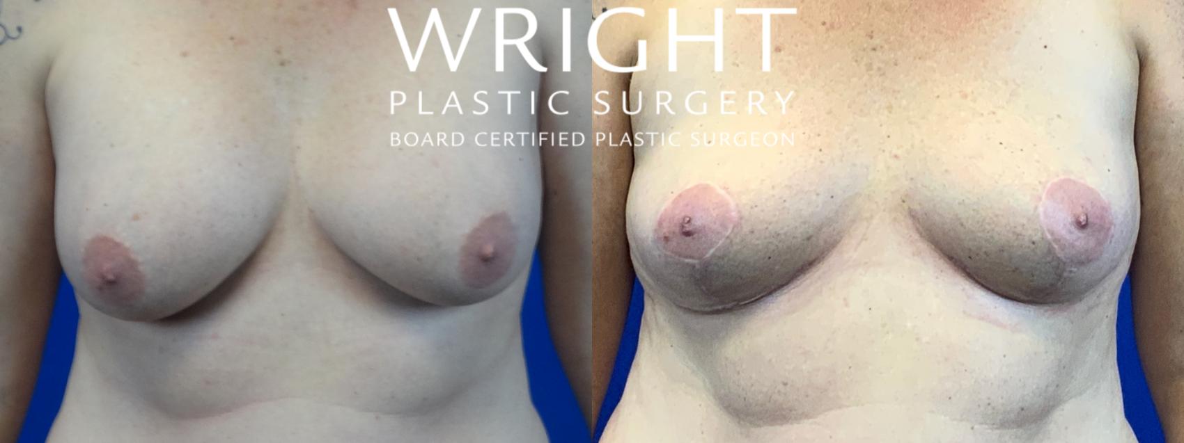 Before & After Breast Lift Case 43 Front View in Little Rock, Arkansas
